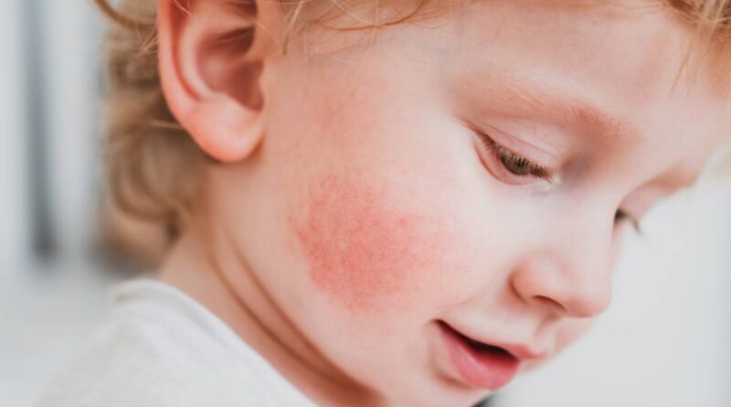 alergická vyrážka a kopřivka u dětí