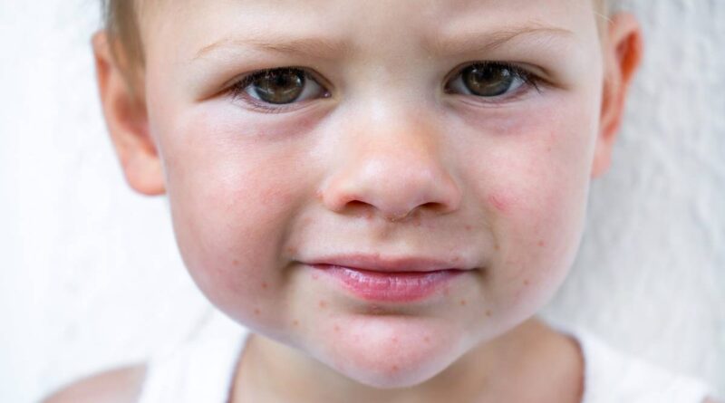 potravinová alergie kopřivka u dětí